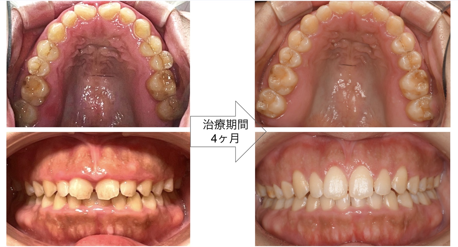 118万円 症例 治療前後（口腔内・治療期間4ヶ月）※個人差あり