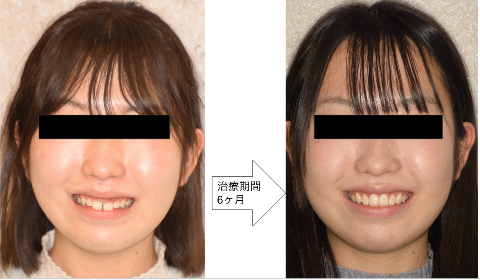 158万円 症例 治療前後（顔・治療期間6ヶ月）※個人差あり