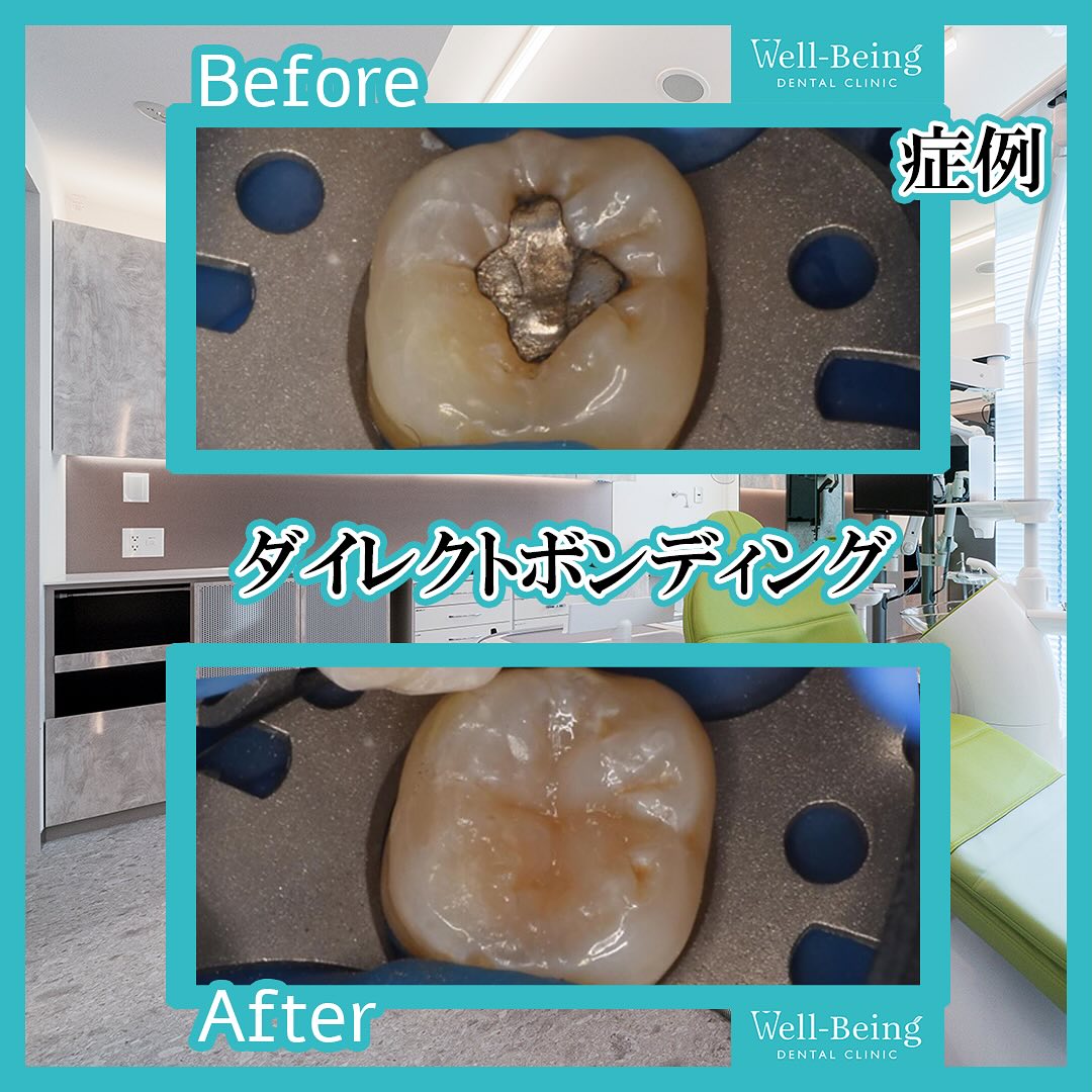 ダイレクトボンディングの治療前後の一例（Before/After）※効果には個人差があります