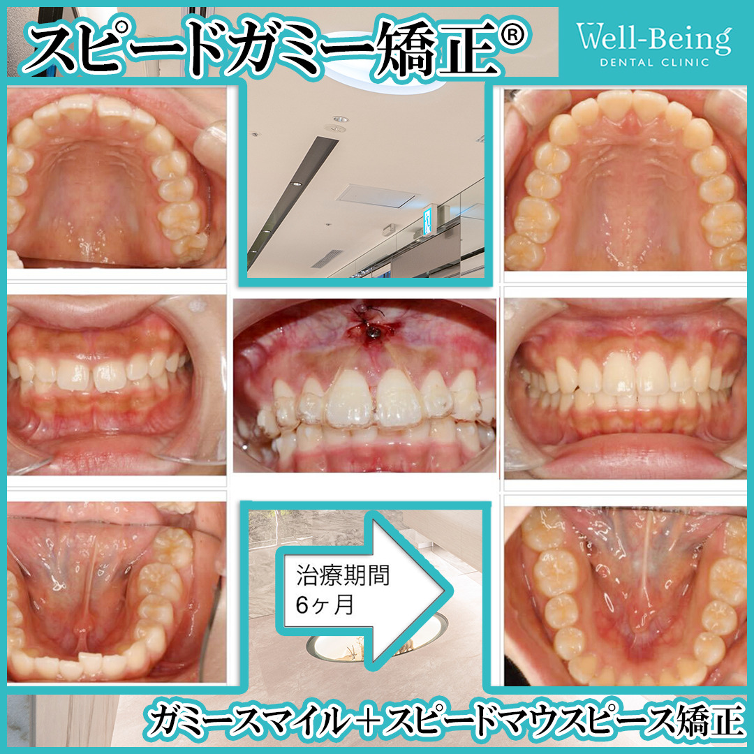 ガミースマイル（歯冠長延長術＋マウスピース矯正）の治療前後の一例（Before/After）※効果には個人差があります