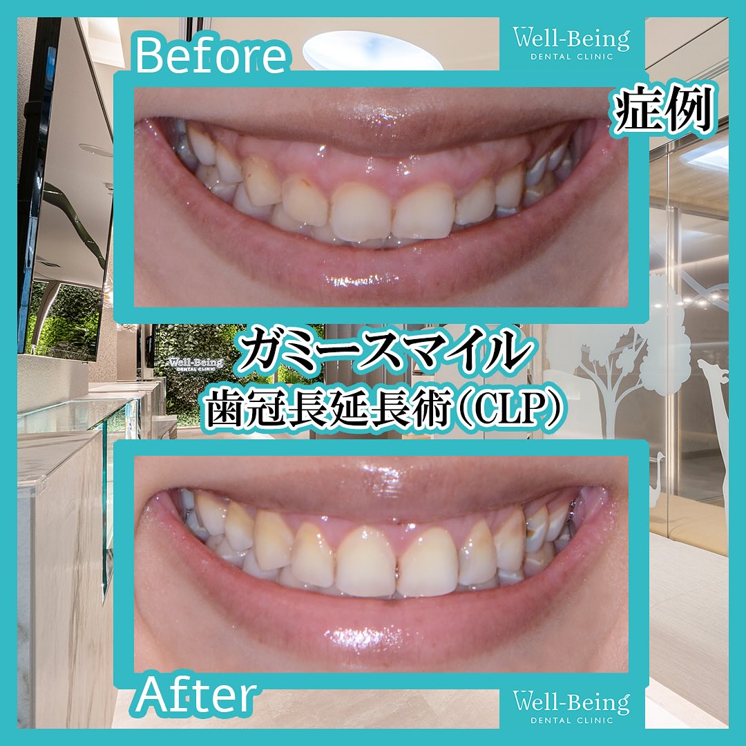 ガミースマイル（歯冠長延長術）の治療前後の一例（Before/After）※効果には個人差があります