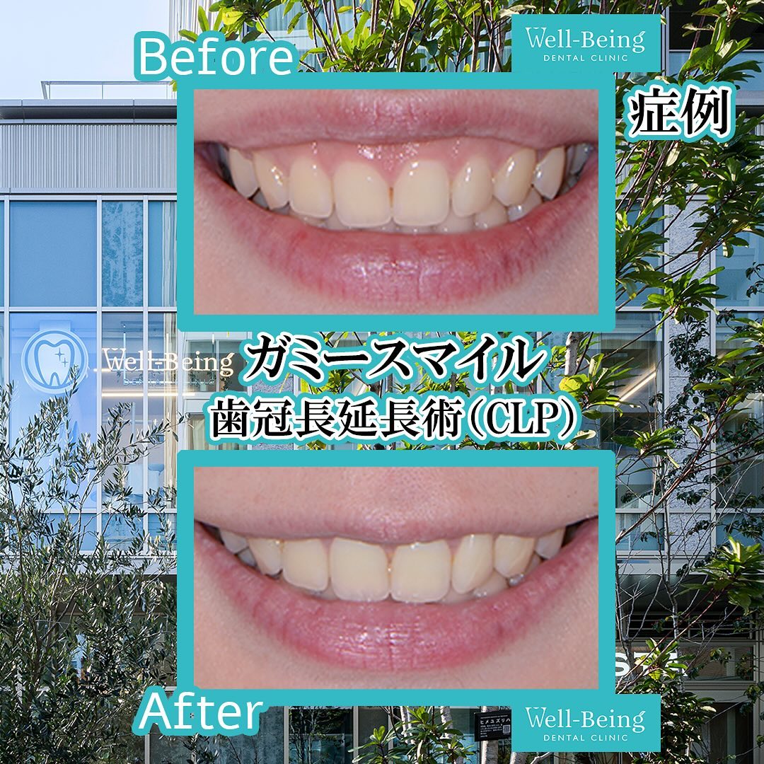 ガミースマイル（歯冠長延長術）の治療前後の一例（Before/After）※効果には個人差があります