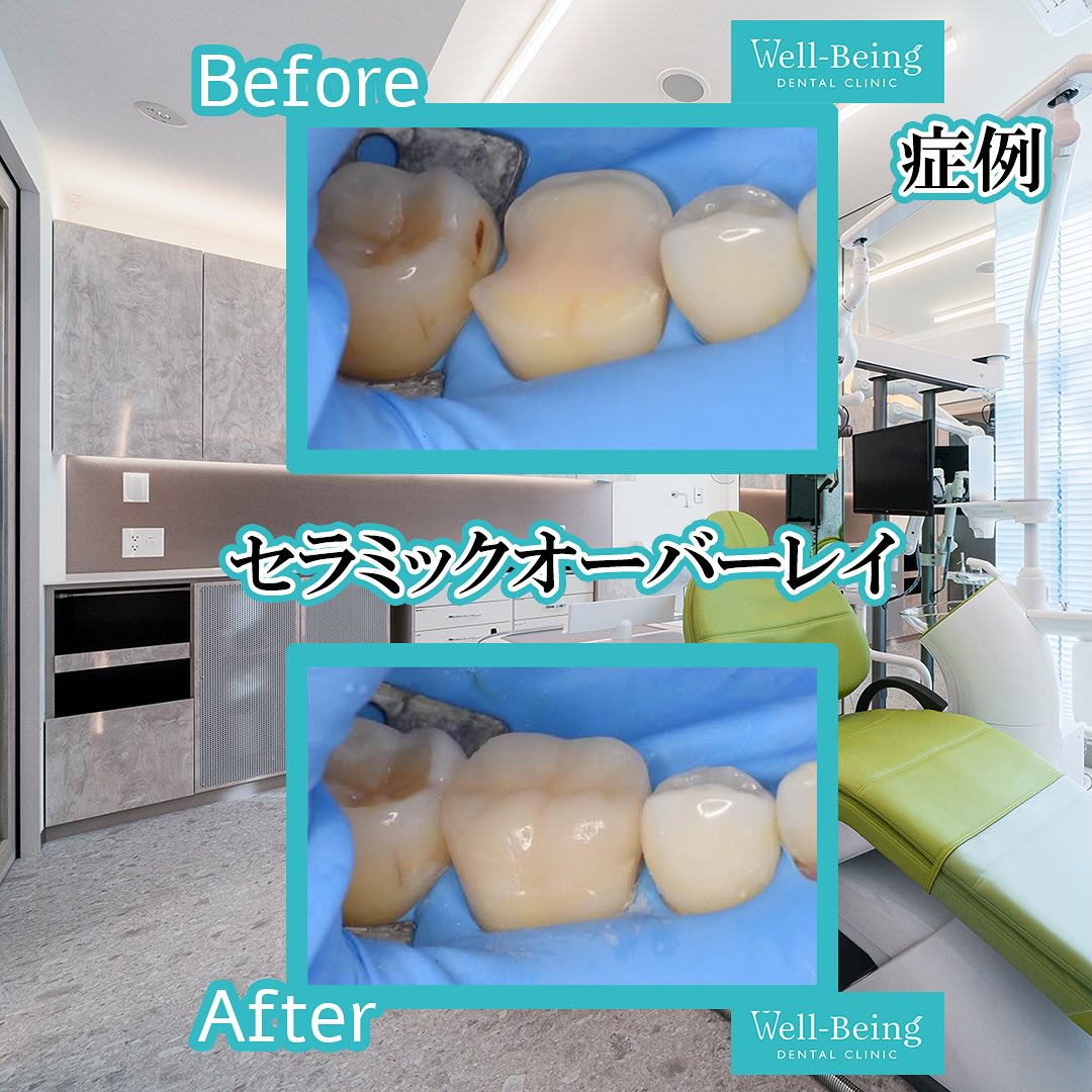 セラミックの治療前後の一例（Before/After）※効果には個人差があります