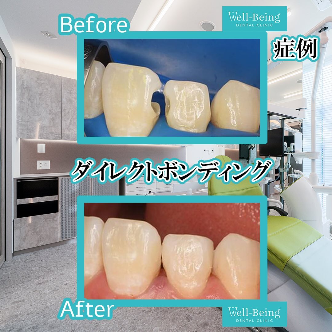 ダイレクトボンディングの治療前後の一例（Before/After）※効果には個人差があります
