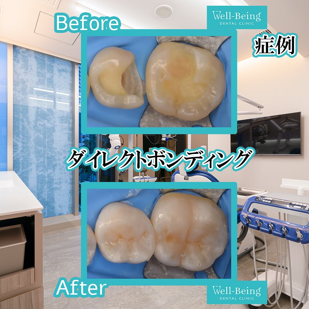 ダイレクトボンディングの治療前後の一例（Before/After）※効果には個人差があります