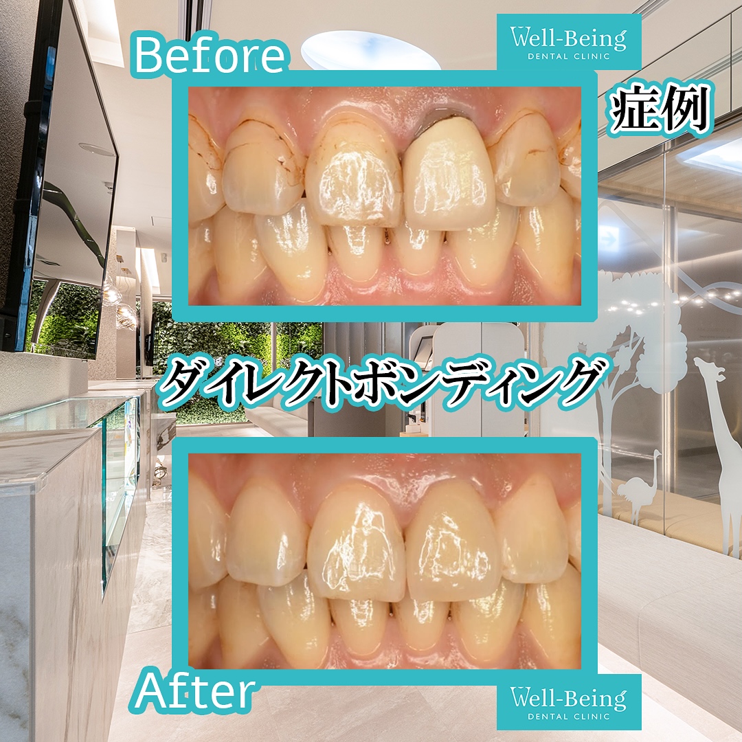 ダイレクトボンディング（すき間）の治療前後の一例（Before/After）※効果には個人差があります