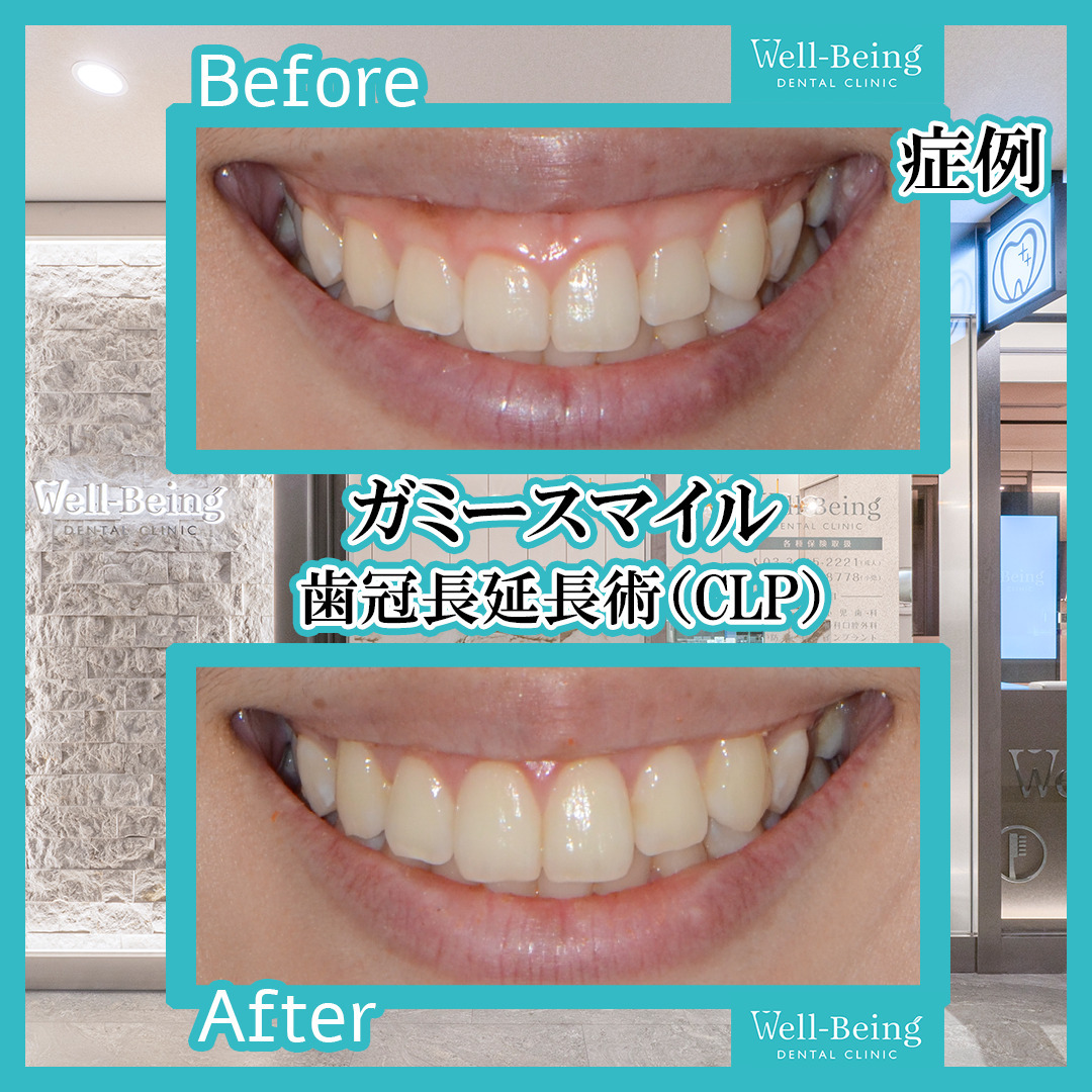 ガミースマイル（歯冠長延長術）の治療前後の一例（Before/After）※効果には個人差があります
