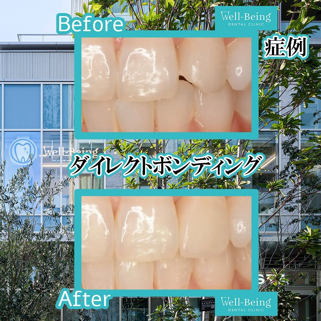 ダイレクトボンディング（すき間）の治療前後の一例（Before/After）※効果には個人差があります