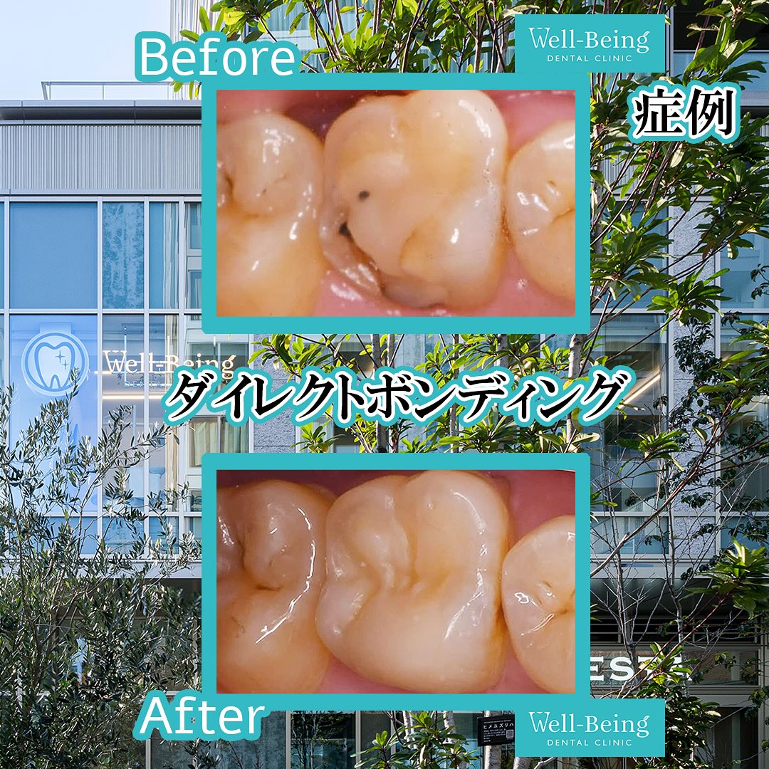 ダイレクトボンディングの治療前後の一例（Before/After）※効果には個人差があります