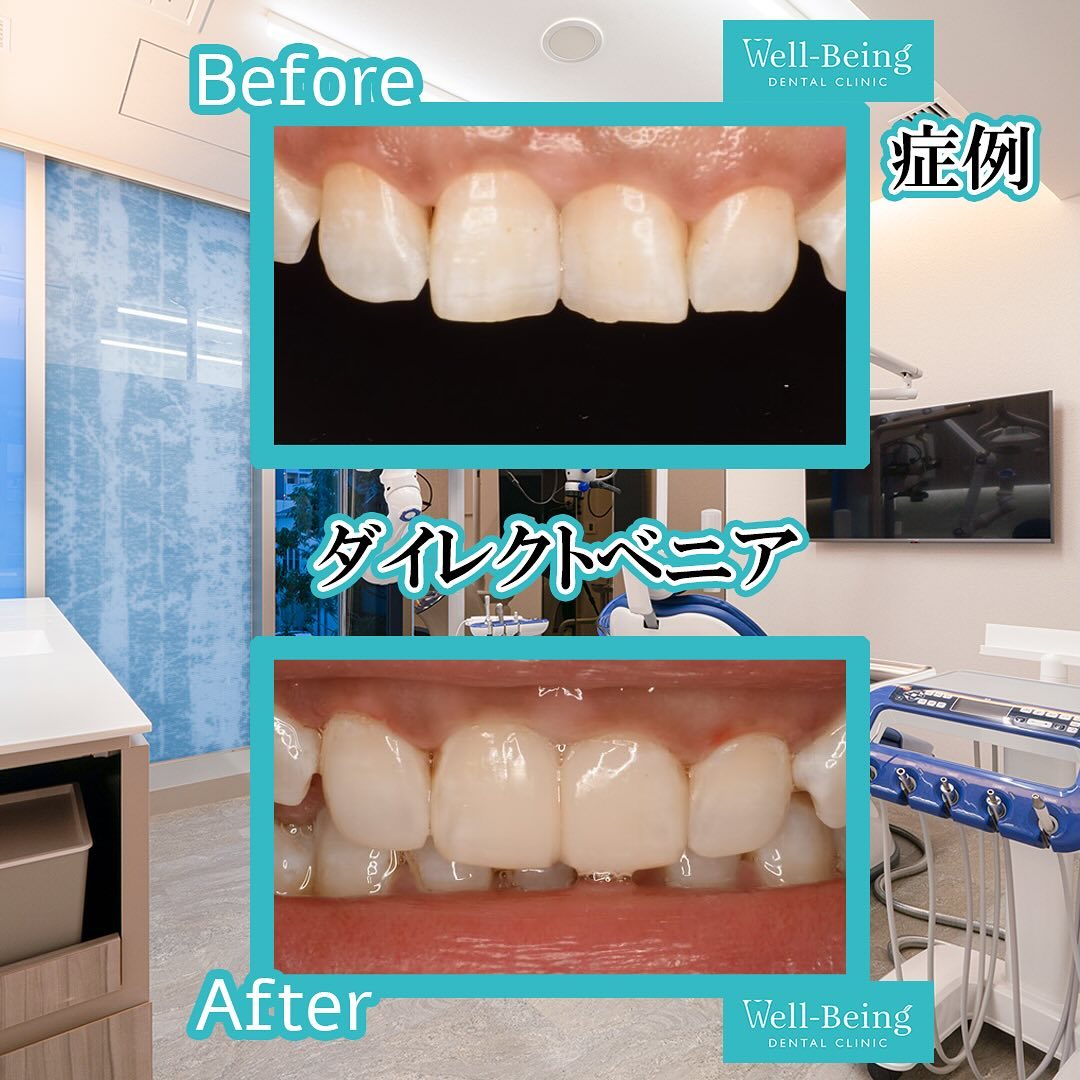 ダイレクトベニアの治療前後の一例（Before/After）※効果には個人差があります