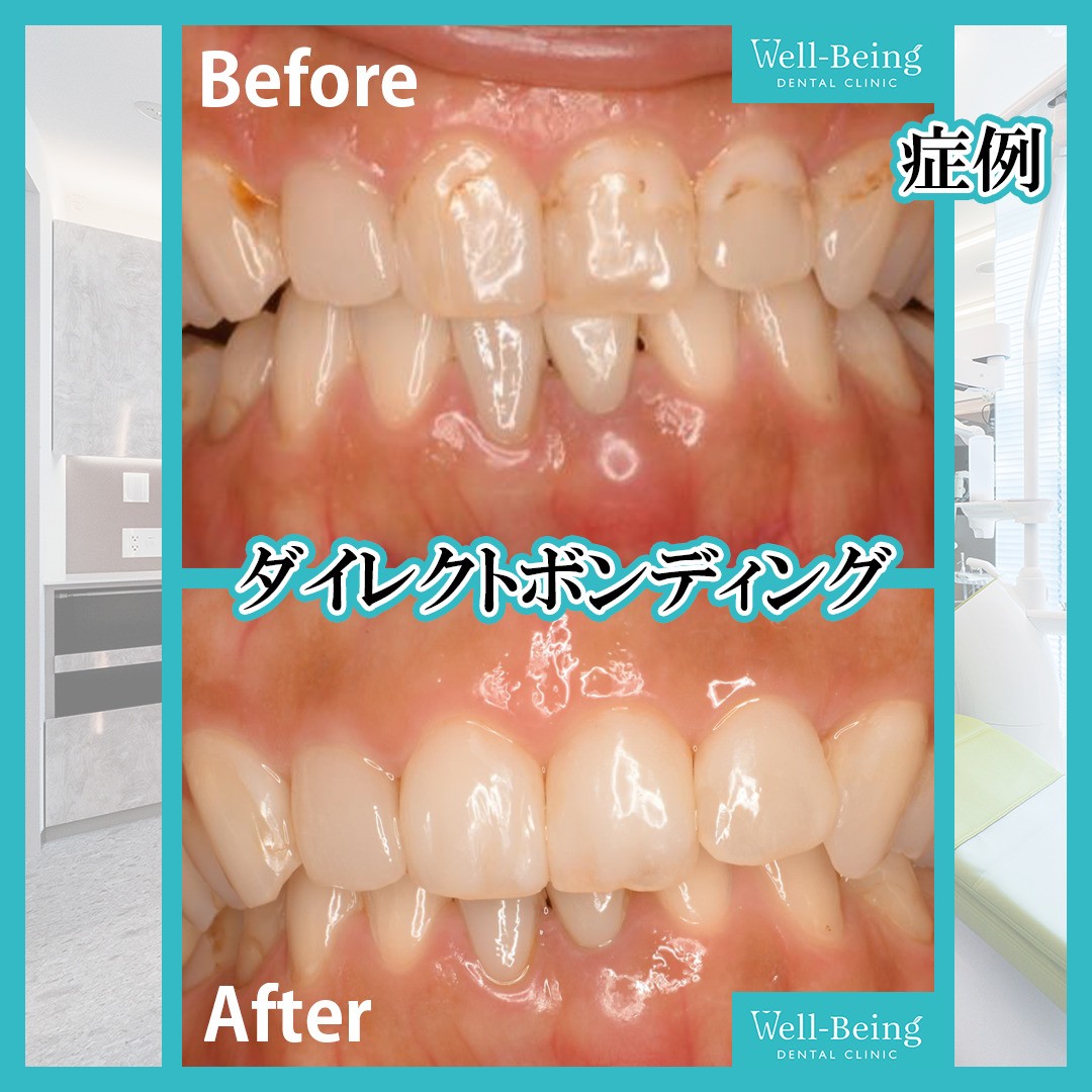 ダイレクトボンディング（すき間）の治療前後の一例（Before/After）※効果には個人差があります