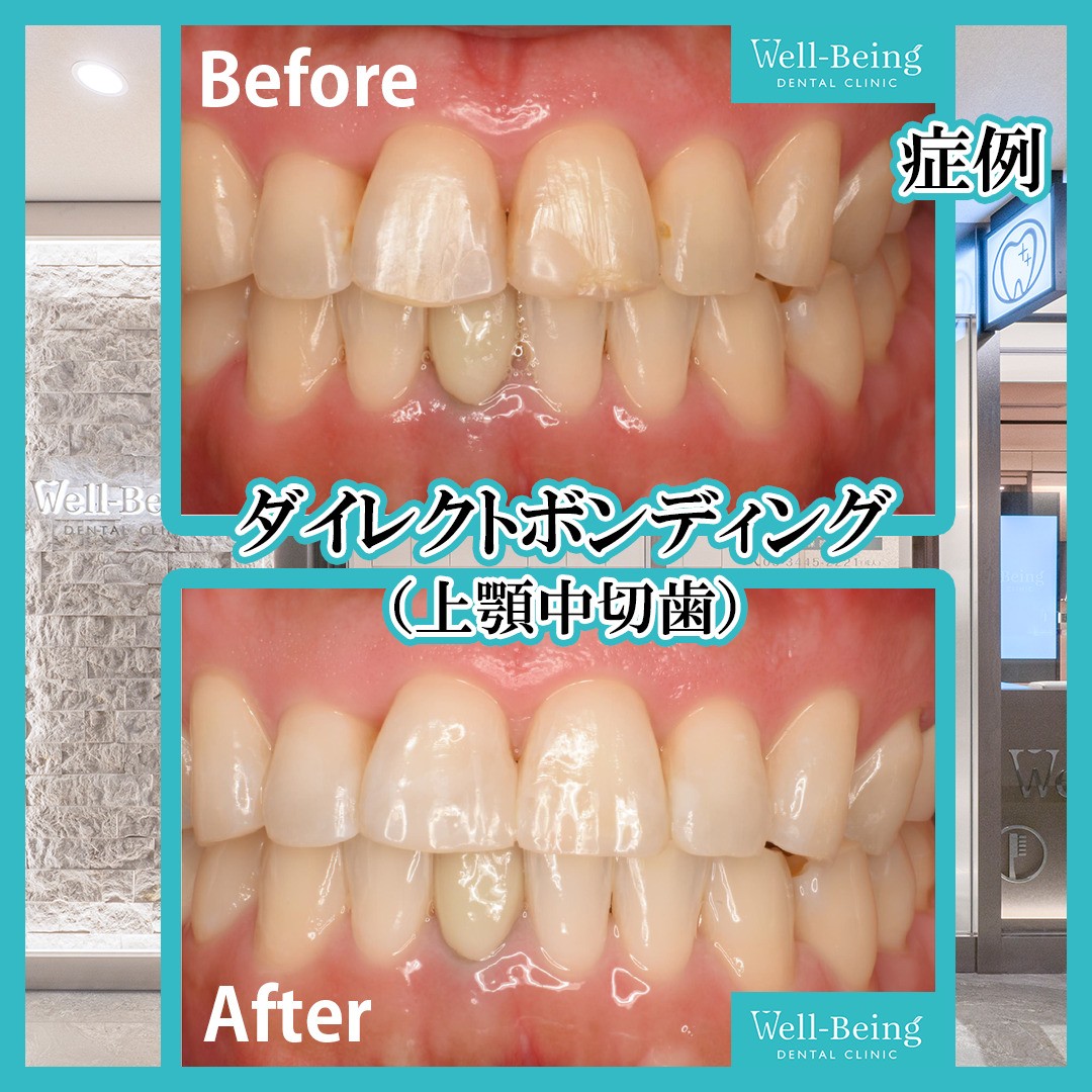 ダイレクトボンディング（すき間）の治療前後の一例（Before/After）※効果には個人差があります