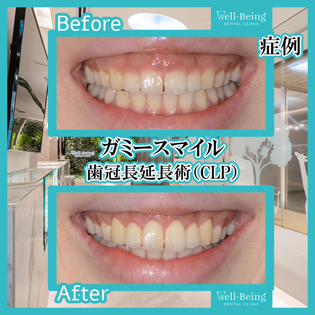 ガミースマイル（歯冠長延長術）の治療前後の一例（Before/After）※効果には個人差があります