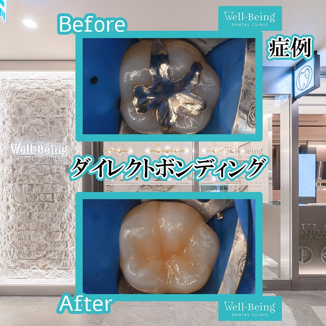 ダイレクトボンディングの治療前後の一例（Before/After）※効果には個人差があります