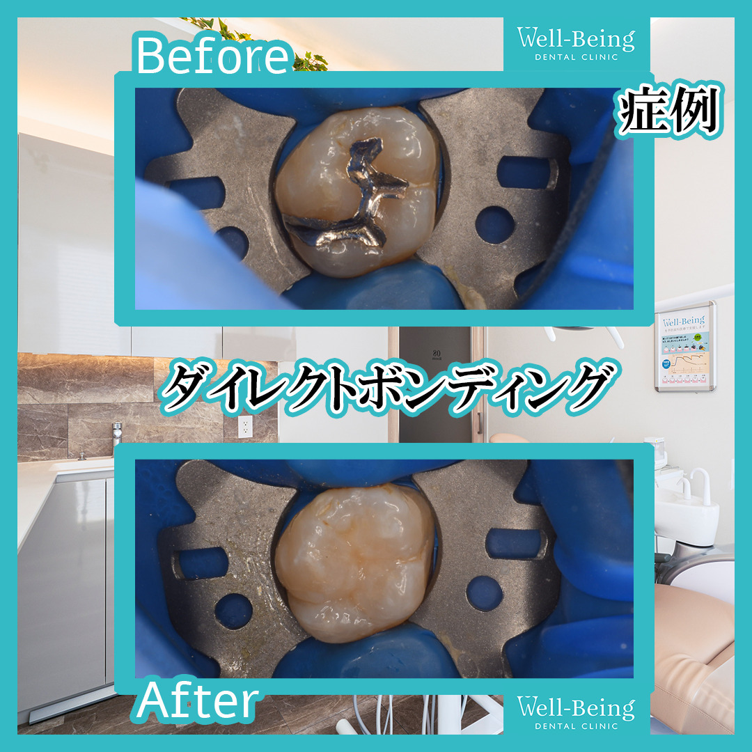 ダイレクトボンディングの治療前後の一例（Before/After）※効果には個人差があります