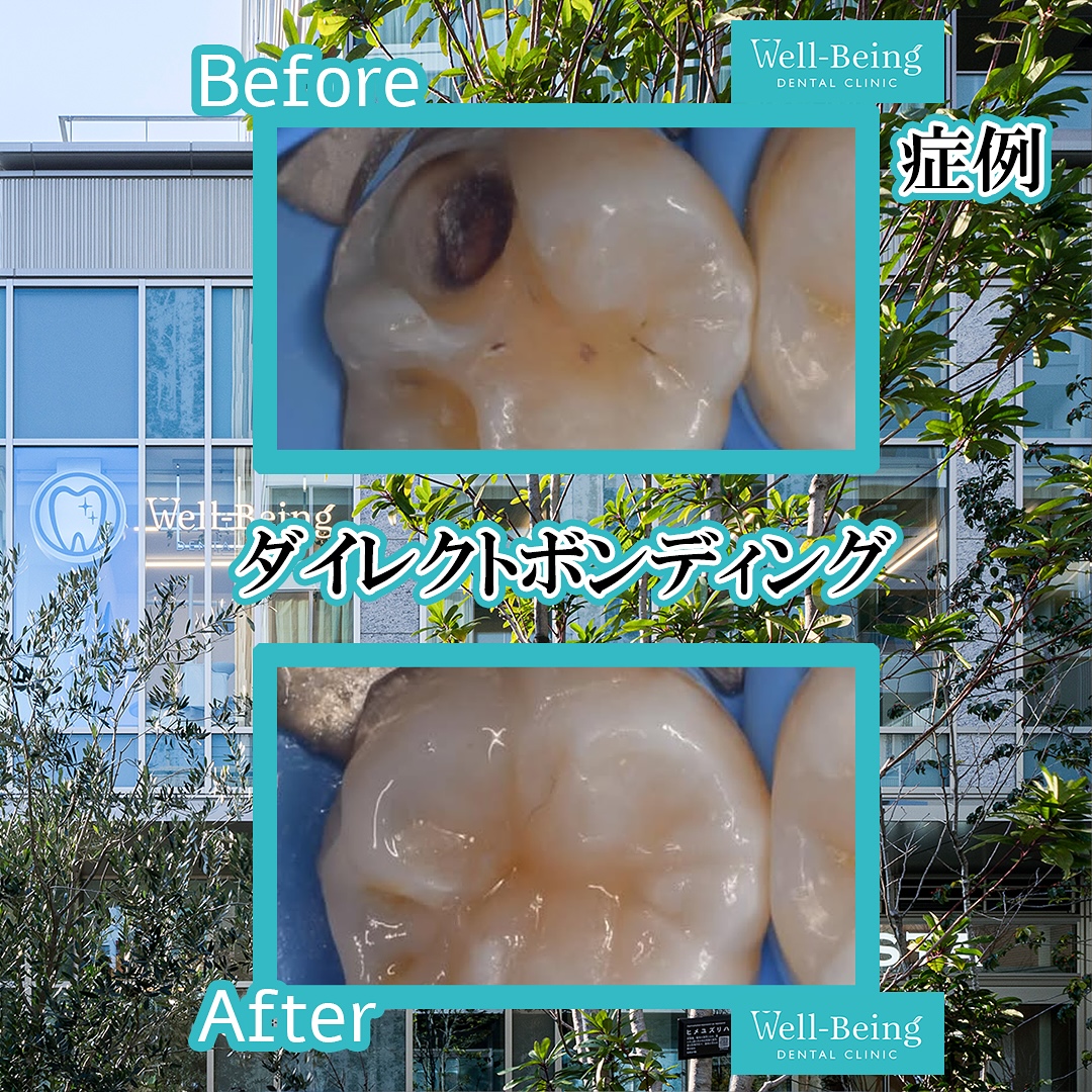 ダイレクトボンディングの治療前後の一例（Before/After）※効果には個人差があります