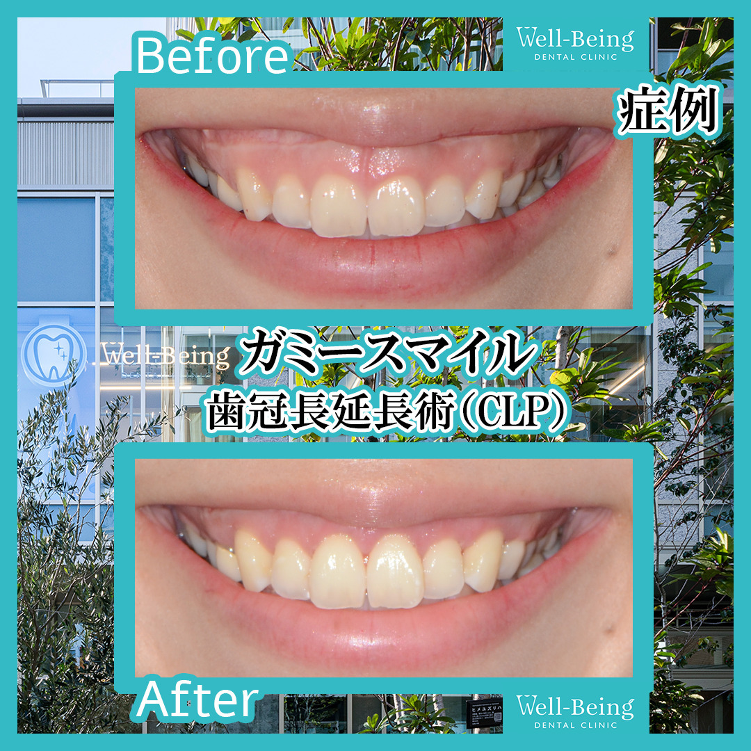 ガミースマイル（歯冠長延長術）の治療前後の一例（Before/After）※効果には個人差があります
