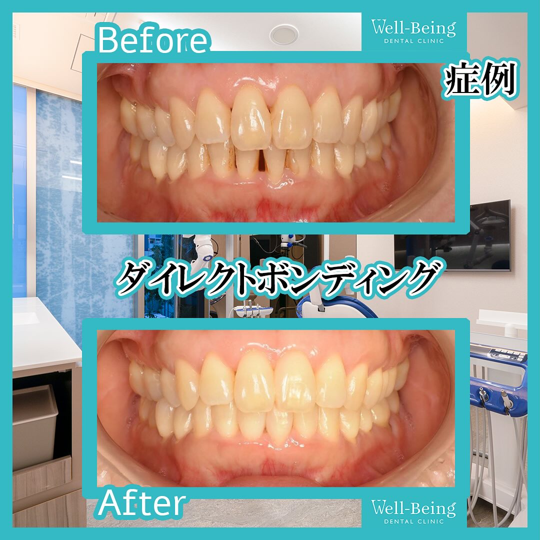 ダイレクトボンディング（すき間）の治療前後の一例（Before/After）※効果には個人差があります