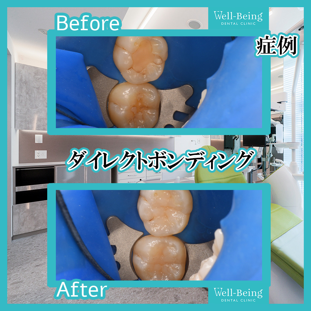 ダイレクトボンディングの治療前後の一例（Before/After）※効果には個人差があります