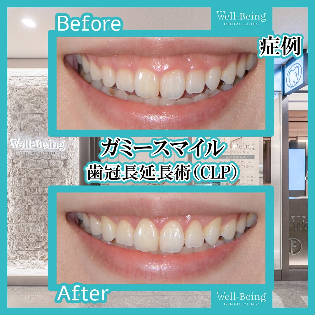 ガミースマイル（歯冠長延長術）の治療前後の一例（Before/After）※効果には個人差があります