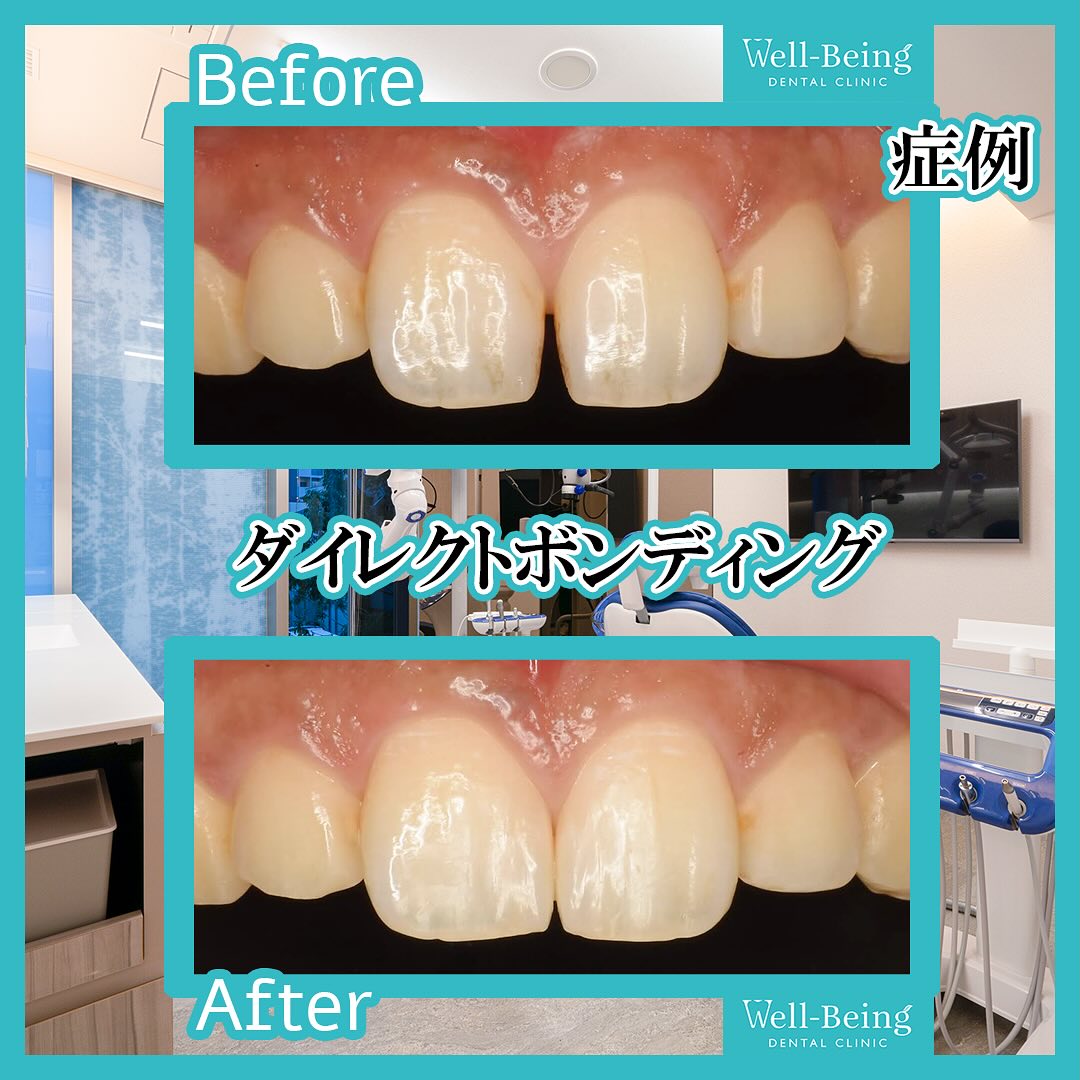 ダイレクトボンディング（すき間）の治療前後の一例（Before/After）※効果には個人差があります