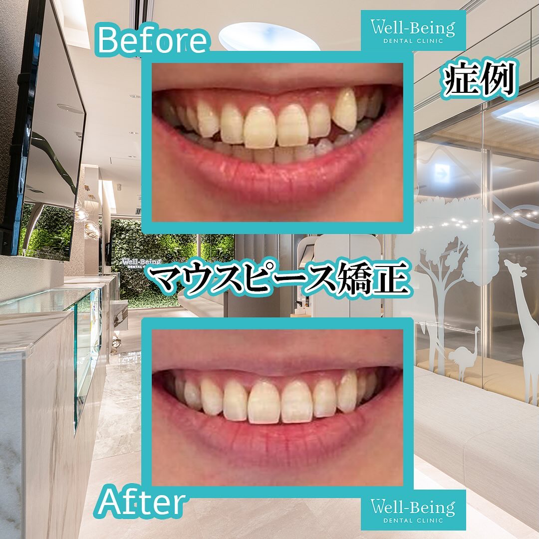 マウスピース矯正（インビザライン）の治療前後の一例（Before/After）※効果には個人差があります