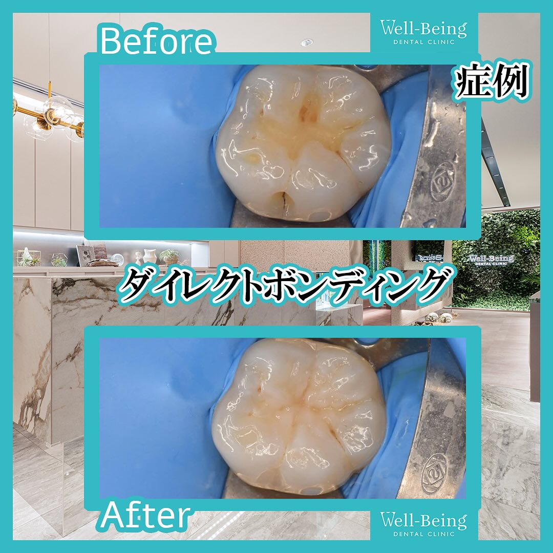 ダイレクトボンディングの治療前後の一例（Before/After）※効果には個人差があります
