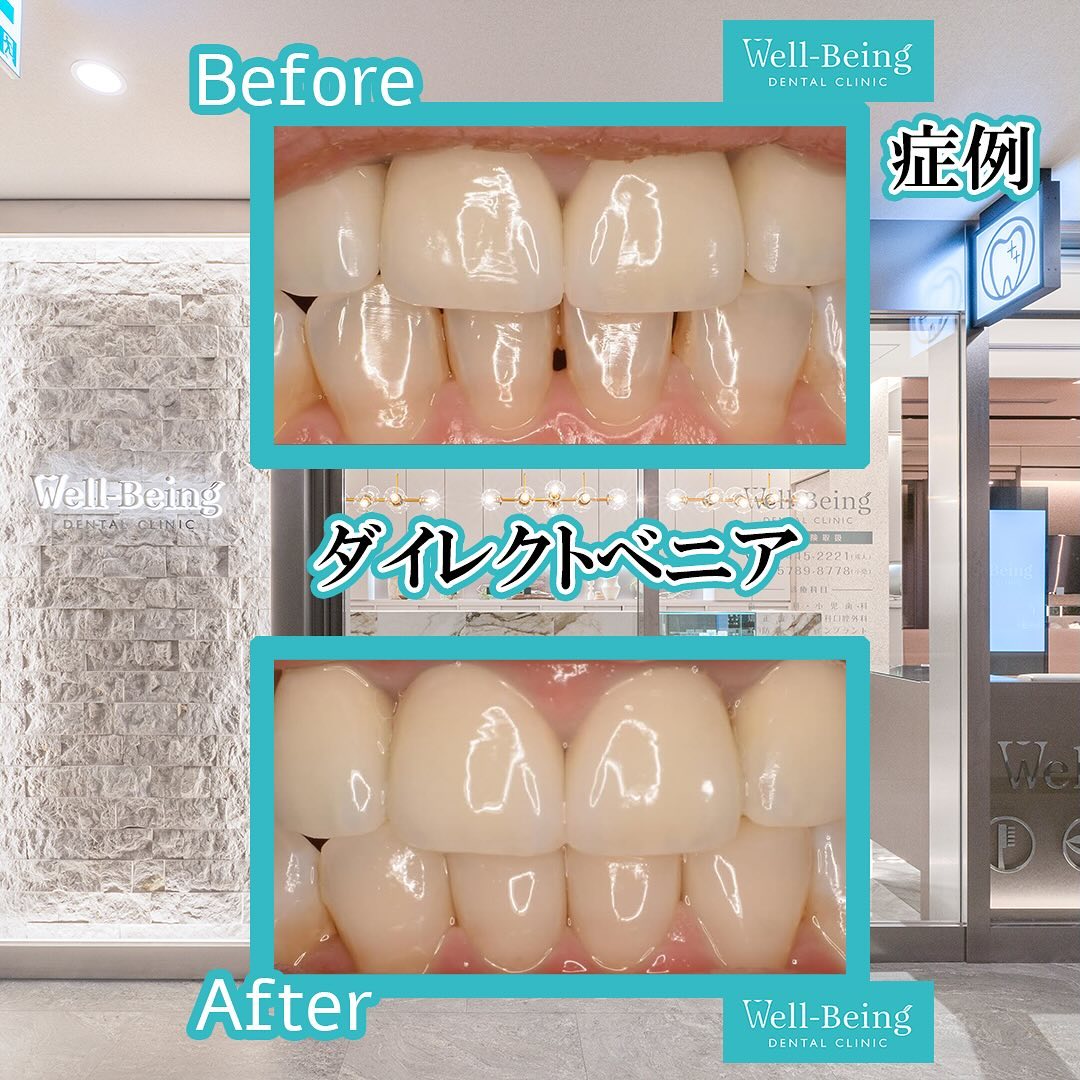 ダイレクトベニアの治療前後の一例（Before/After）※効果には個人差があります