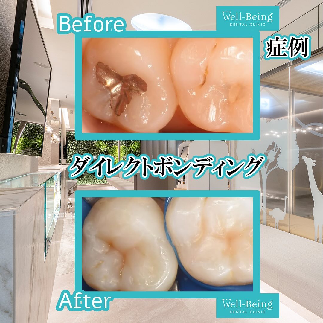 ダイレクトボンディングの治療前後の一例（Before/After）※効果には個人差があります