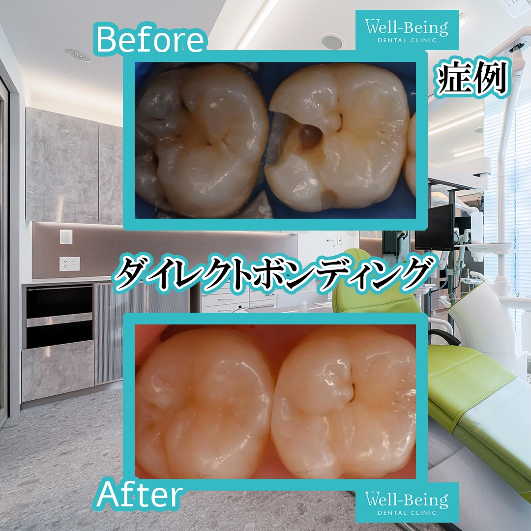 ダイレクトボンディングの治療前後の一例（Before/After）※効果には個人差があります
