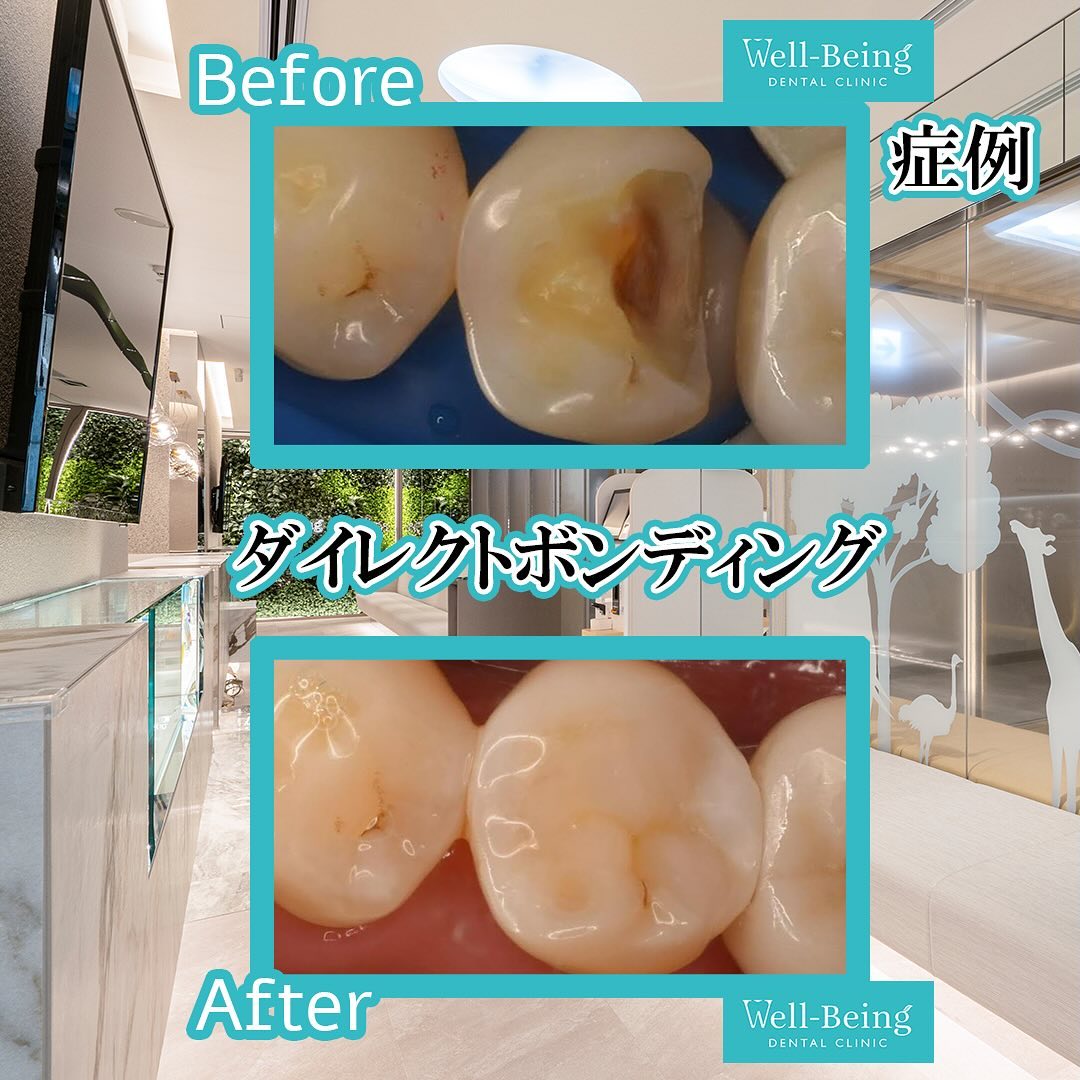 ダイレクトボンディングの治療前後の一例（Before/After）※効果には個人差があります