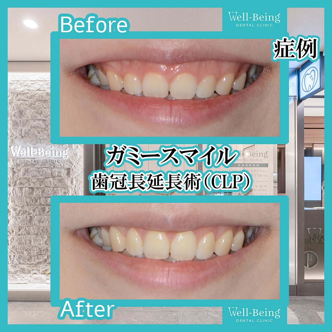 ガミースマイル（歯冠長延長術）の治療前後の一例（Before/After）※効果には個人差があります