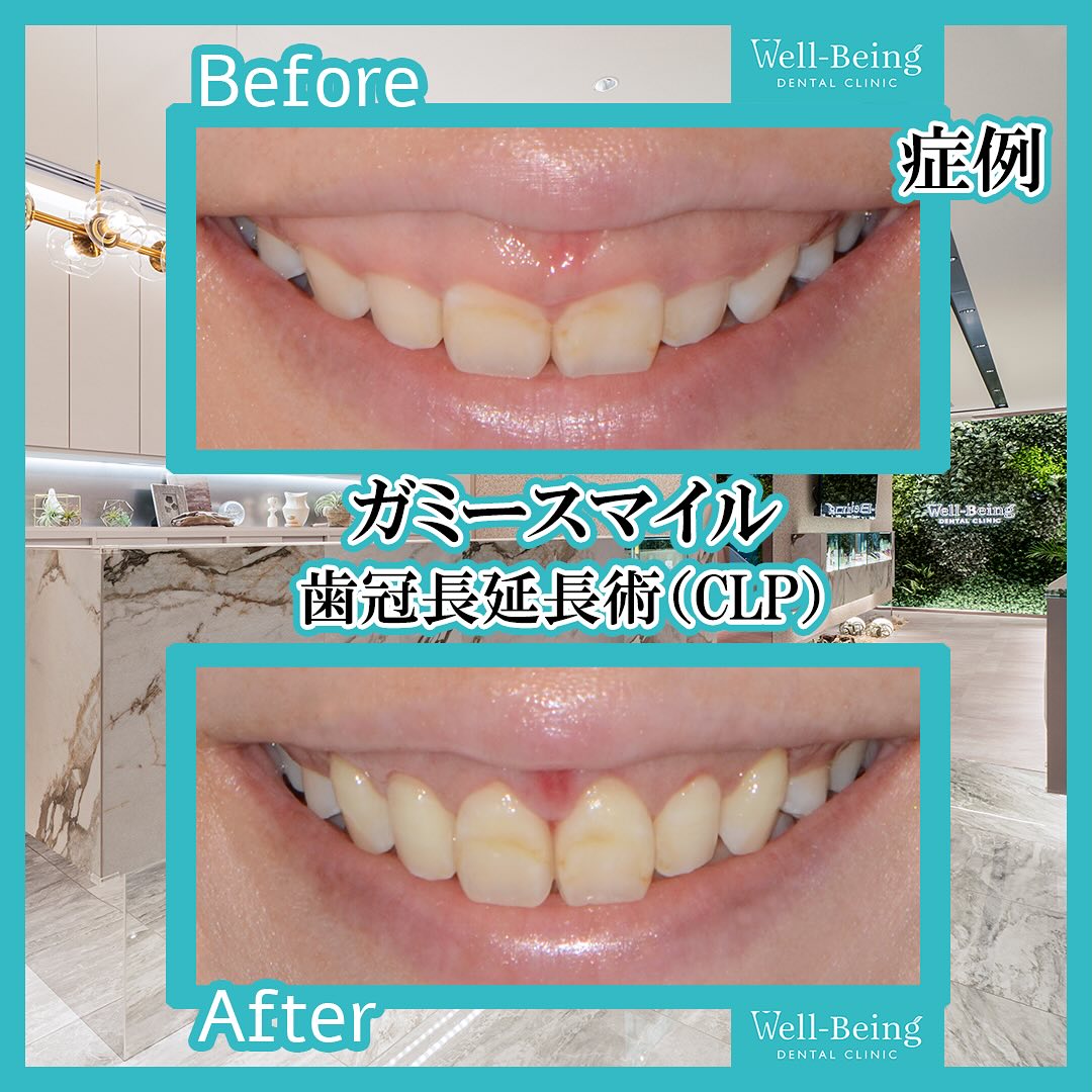 ガミースマイル（歯冠長延長術）の治療前後の一例（Before/After）※効果には個人差があります