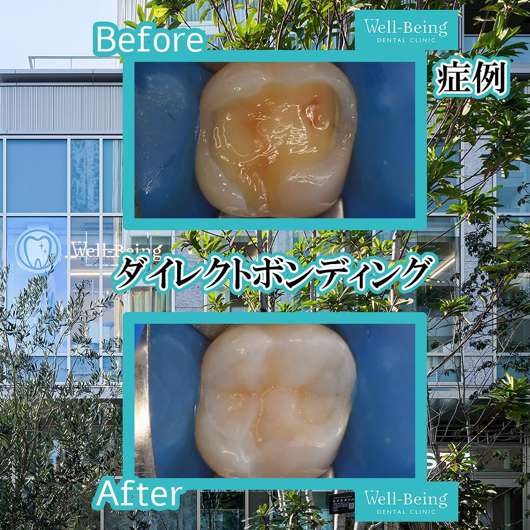 ダイレクトボンディングの治療前後の一例（Before/After）※効果には個人差があります