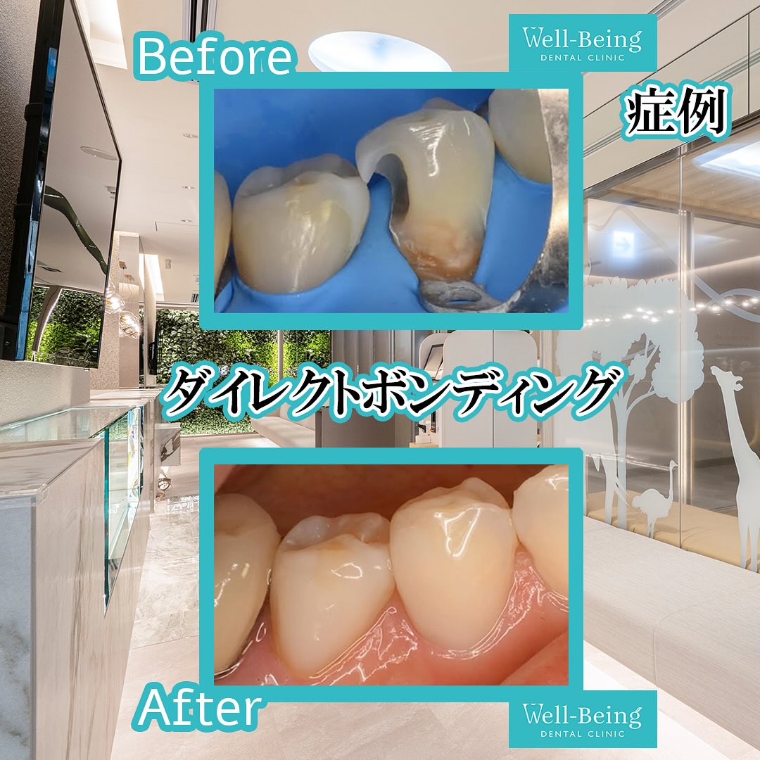 ダイレクトボンディングの治療前後の一例（Before/After）※効果には個人差があります