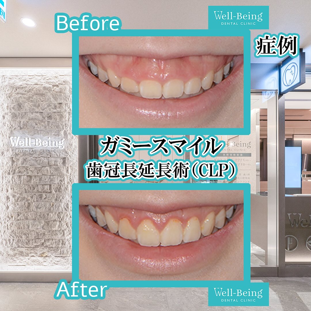 ガミースマイル（歯冠長延長術）の治療前後の一例（Before/After）※効果には個人差があります