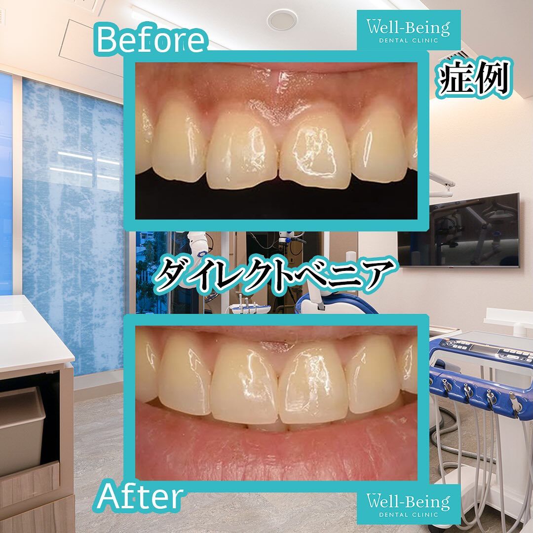 ダイレクトベニアの治療前後の一例（Before/After）※効果には個人差があります
