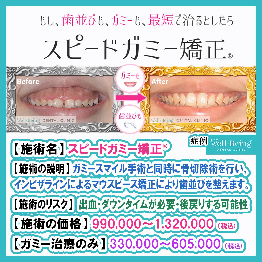 スピードガミー矯正®（歯冠長延長術＋マウスピース矯正）の治療前後の一例（Before/After）※効果には個人差があります