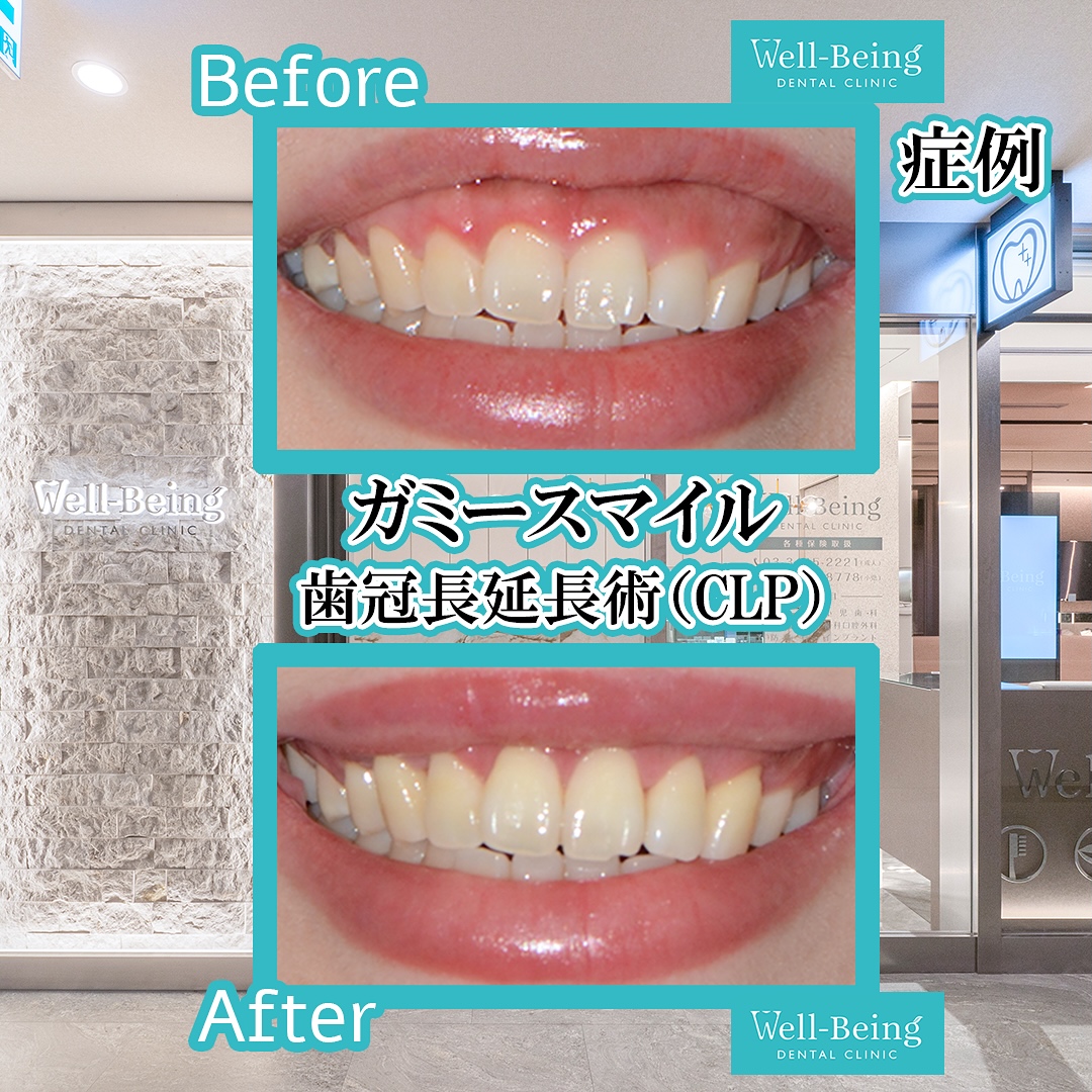ガミースマイル（歯冠長延長術）の治療前後の一例（Before/After）※効果には個人差があります