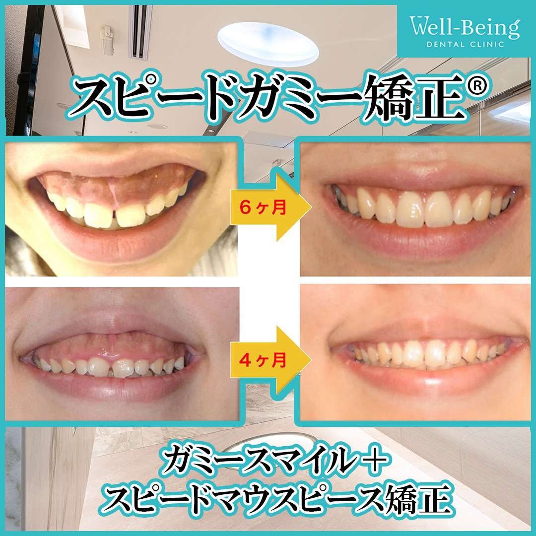 ガミースマイル（歯冠長延長術＋マウスピース矯正）の治療前後の一例（Before/After）※効果には個人差があります