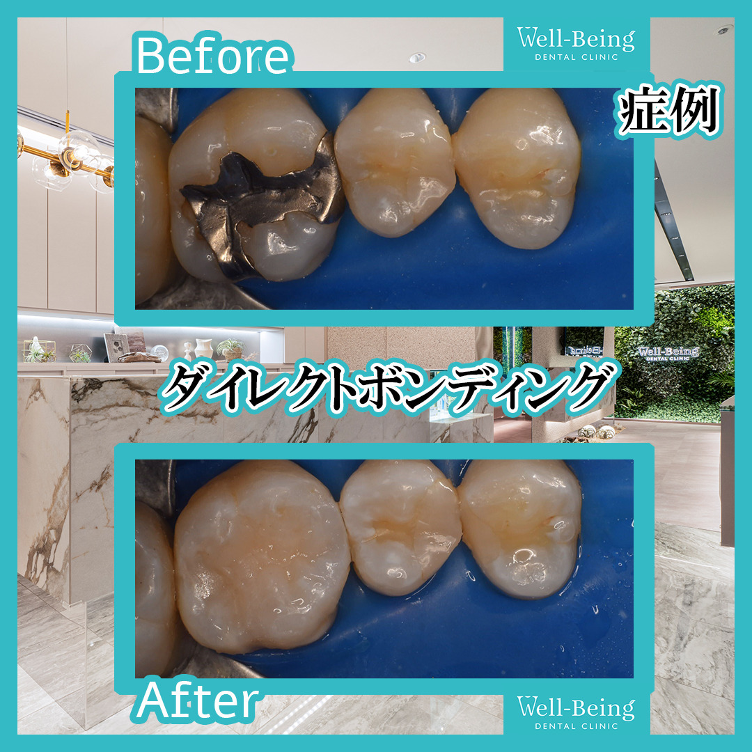 ダイレクトボンディングの治療前後の一例（Before/After）※効果には個人差があります