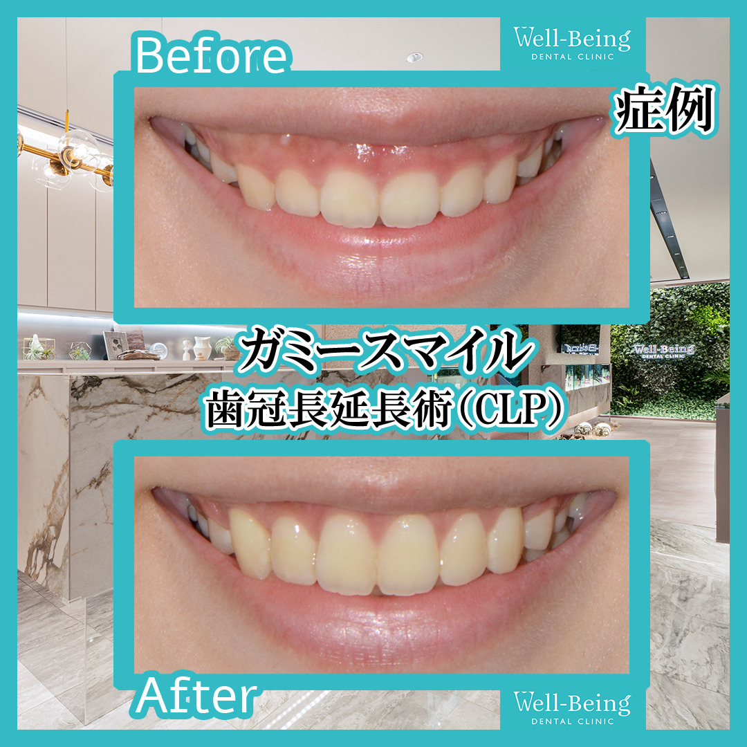 ガミースマイル（歯冠長延長術）の治療前後の一例（Before/After）※効果には個人差があります