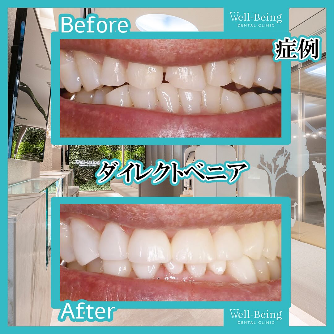 ダイレクトベニアの治療前後の一例（Before/After）※効果には個人差があります