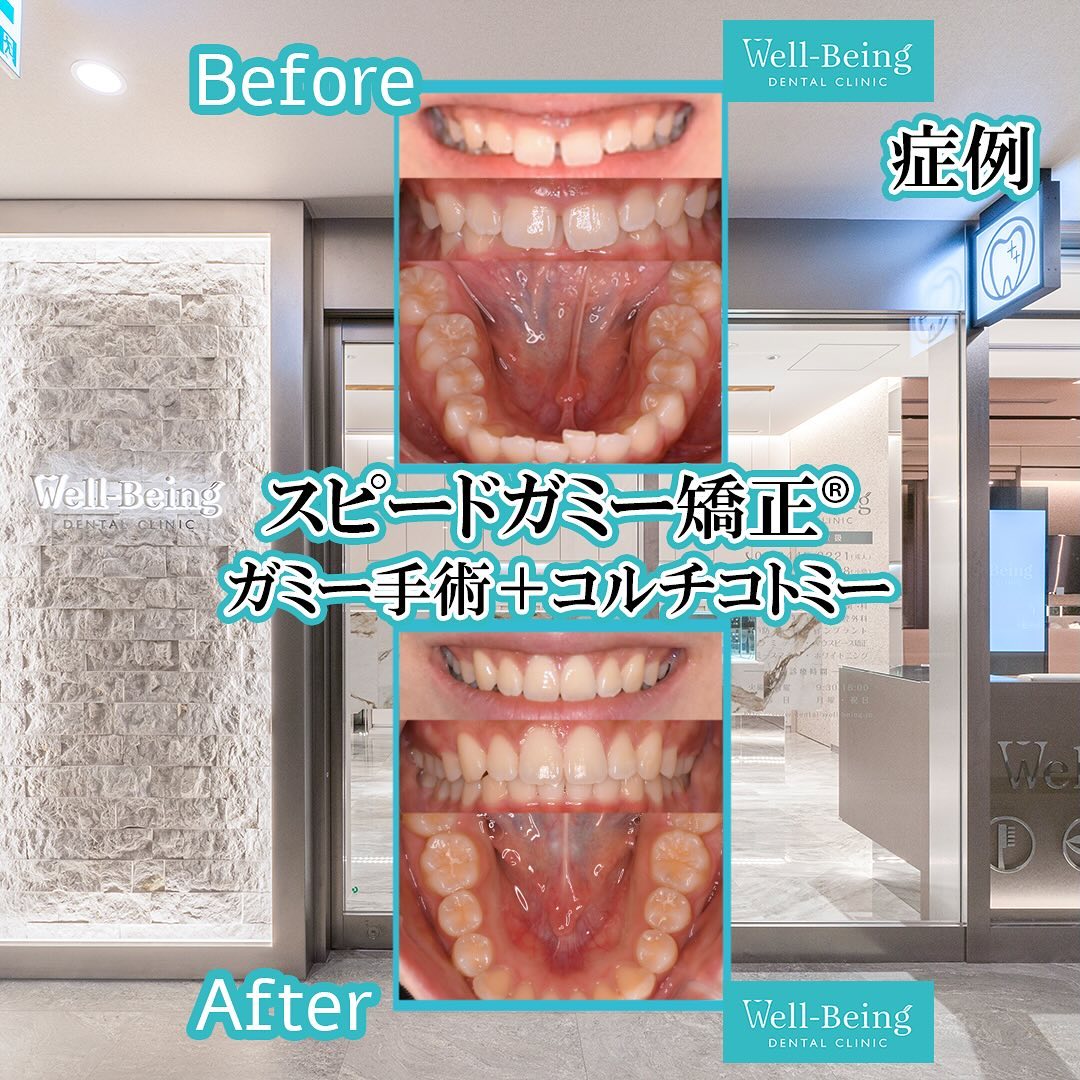 スピードガミー矯正®（歯冠長延長術＋マウスピース矯正）の治療前後の一例（Before/After）※効果には個人差があります