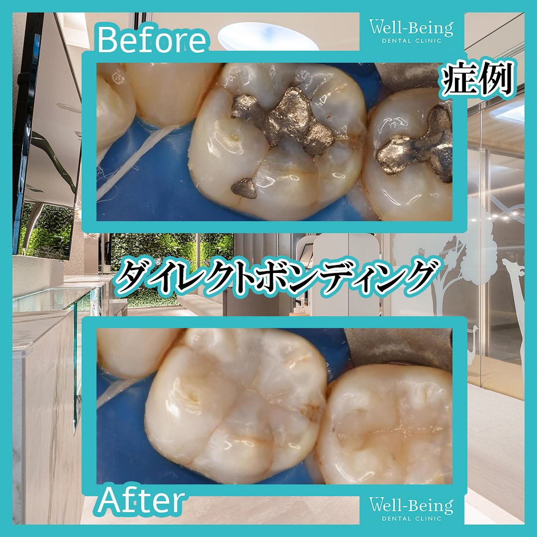 ダイレクトボンディングの治療前後の一例（Before/After）※効果には個人差があります
