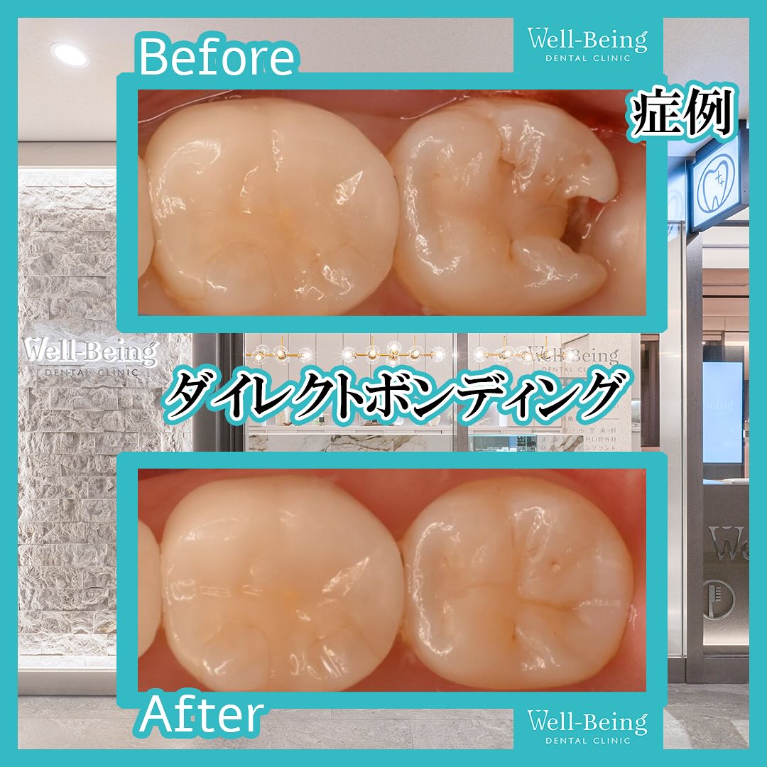 ダイレクトボンディングの治療前後の一例（Before/After）※効果には個人差があります