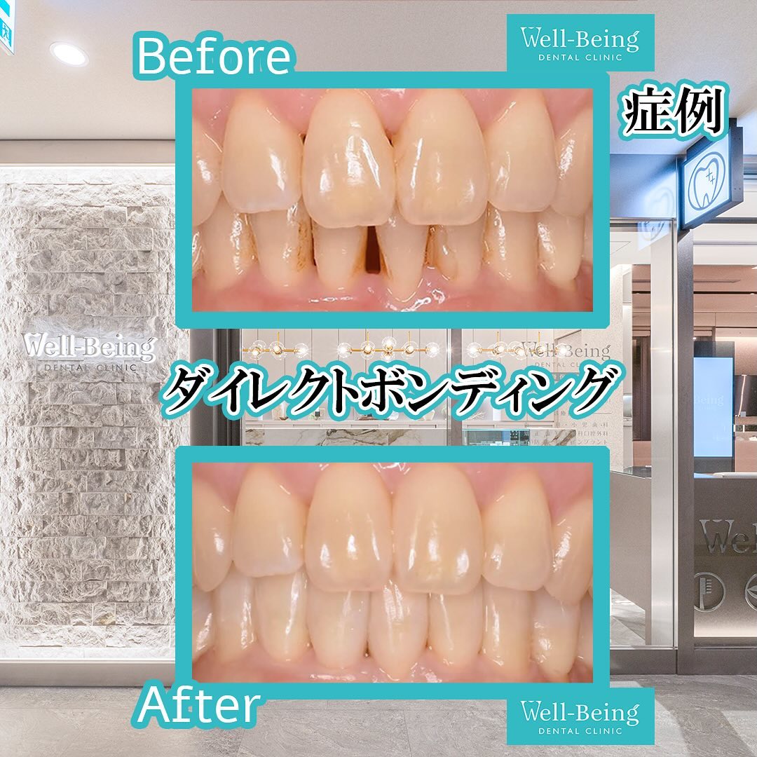 ダイレクトボンディング（すき間）の治療前後の一例（Before/After）※効果には個人差があります